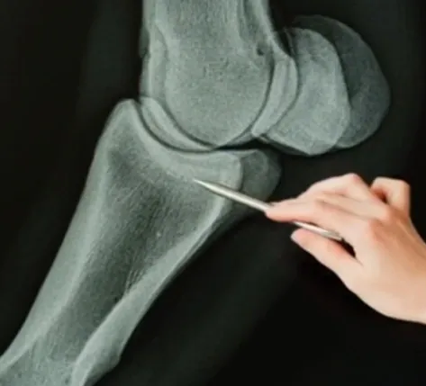 Knee x-ray with a pen pointing to the joint space